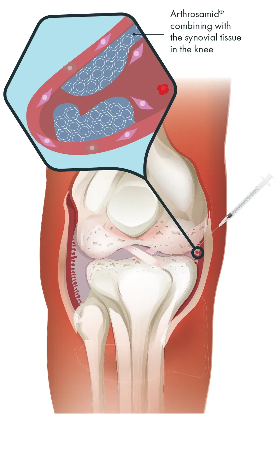 Howto, Ultrasound Injections at Physio & More, Kingston